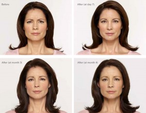 Botox before and after