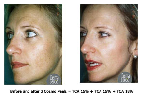 Pre and post cosmo peel