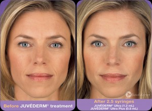 juvederm_before_after